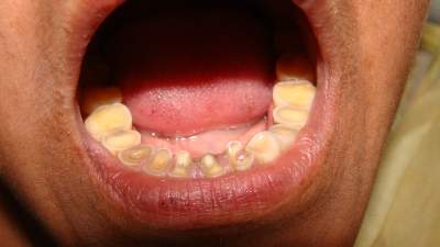 मुंह से बदबू व दांतों की सड़न दूर करने का उपाय !